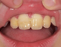 受傷1カ月の歯と唇